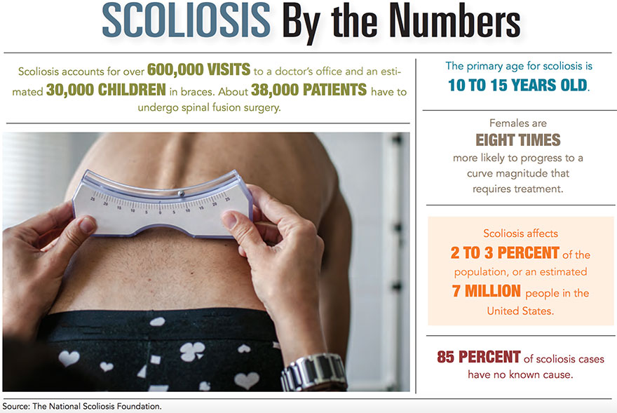 Scoliosis by the Numbers